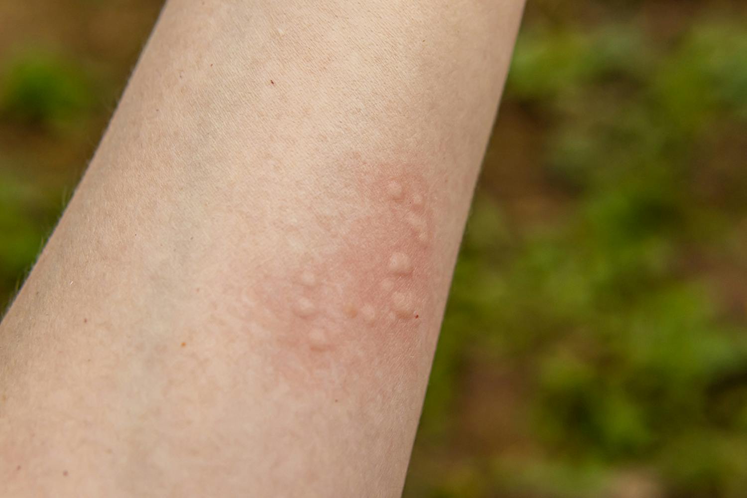 Brændt af brændenælder Hvad hjælper mod brændenælder?